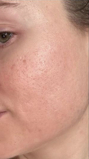 Фото ПОСЛЕ процедуры: Реабилитация после СО2 лазерной шлифовки