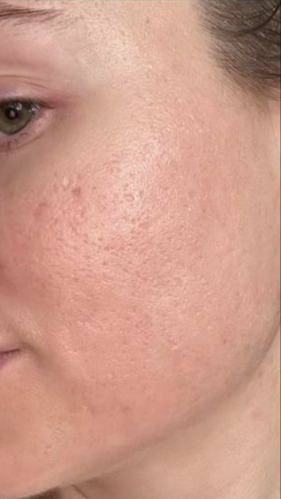 Фото ПОСЛЕ процедуры: Реабилитация после СО2 лазерной шлифовки