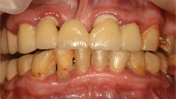 Фото ДО процедуры: Пародонтит тяжелой степени