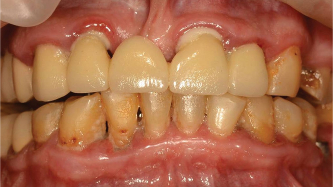 Фото ДО процедуры: Пародонтит тяжелой степени