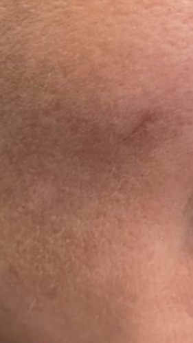 Фото ПОСЛЕ процедуры: Гипертрофический рубец