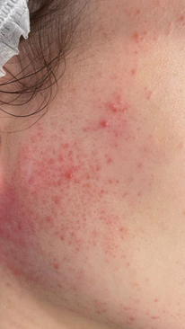 Фото ДО процедуры: Розацеа