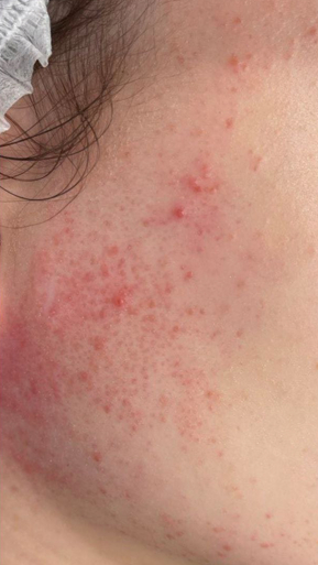 Фото ПОСЛЕ процедуры: Розацеа