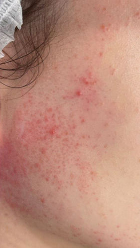 Фото ДО процедуры: Розацеа