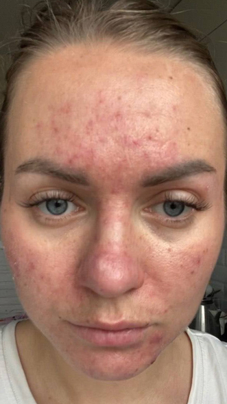Фото ДО процедуры: Акне Розацеа