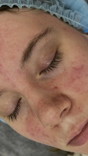 Фото ДО процедуры: Снятие обострения розацеа