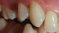 Фото ПОСЛЕ процедуры: Гингивит и легкая степень пародонтита