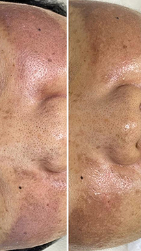 Фото ДО процедуры: Пигментация