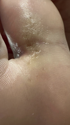 Фото ДО процедуры: Подошвенные бородавки