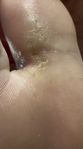 Фото ДО процедуры: Подошвенные бородавки