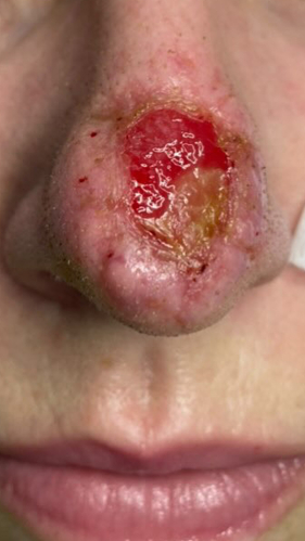 Фото ДО процедуры: Открытая рана носа