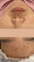 Фото ПОСЛЕ процедуры: Акне