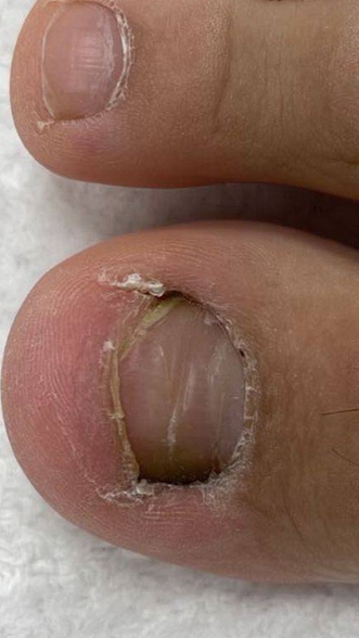 Фото ДО процедуры: Онихолизис