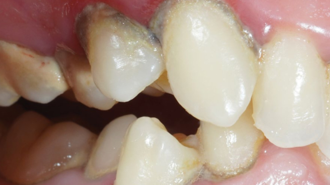 Фото ПОСЛЕ процедуры: Гингивит и легкая степень пародонтита