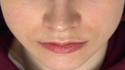 Фото ПОСЛЕ процедуры: Розацеа