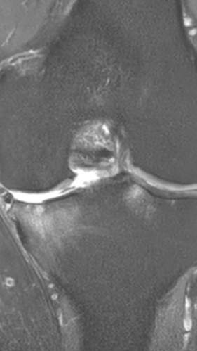 Фото ДО процедуры: Асептический некроз коленного сустава