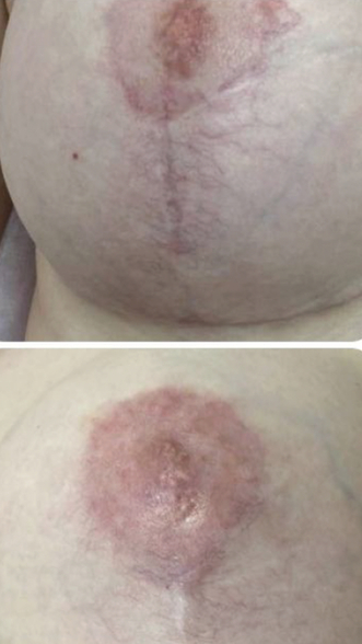 Фото ПОСЛЕ процедуры: Некроз и отёк ореол