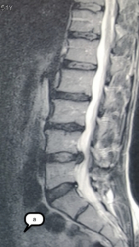 Фото ПОСЛЕ процедуры: Грыжа Диска L4-L5