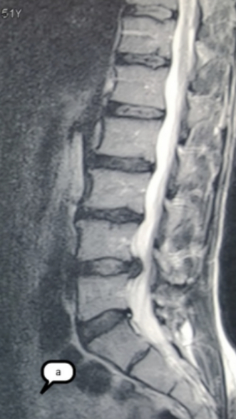 Фото ПОСЛЕ процедуры: Грыжа Диска L4-L5