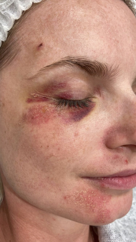 Фото ДО процедуры: Реабилитация после падения