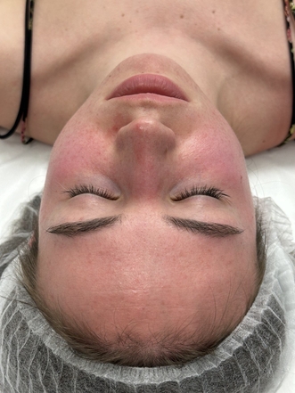 Фото ДО процедуры: Розацеа