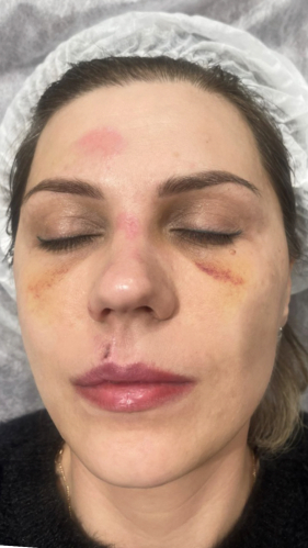 Фото ДО процедуры: Реабилитация после падения