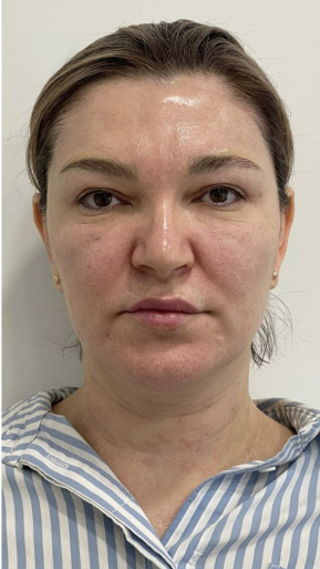 Фото ПОСЛЕ процедуры: Усталость и отечность лица