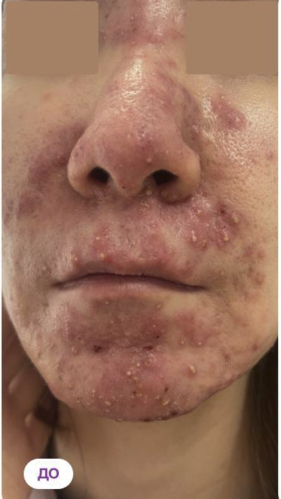 Фото ДО процедуры: Акне и розацеа