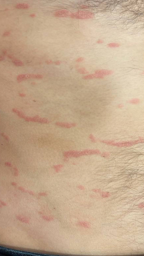 Фото ПОСЛЕ процедуры: Псориаз тела