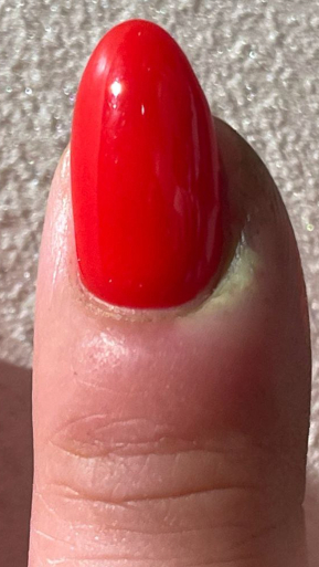 Фото ДО процедуры: Панариций