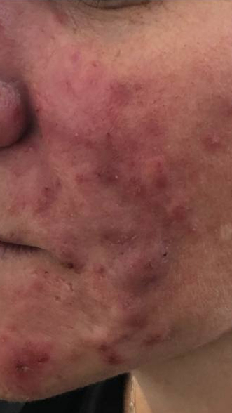 Фото ДО процедуры: Розацеа