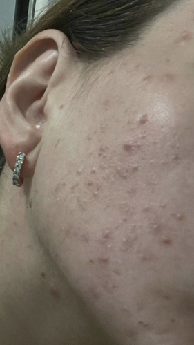 Фото ДО процедуры: Акне