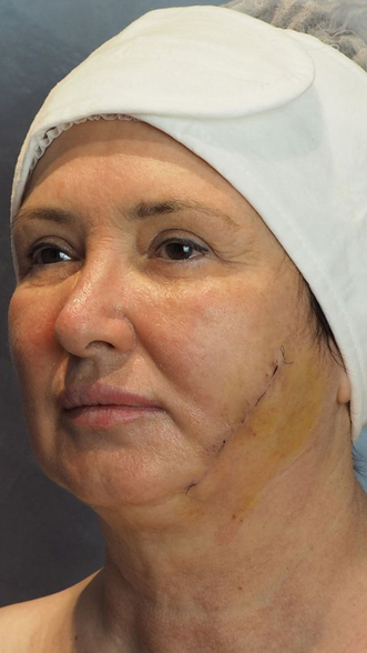 Фото ДО процедуры: Осложнение после лазерного эндолифтинга