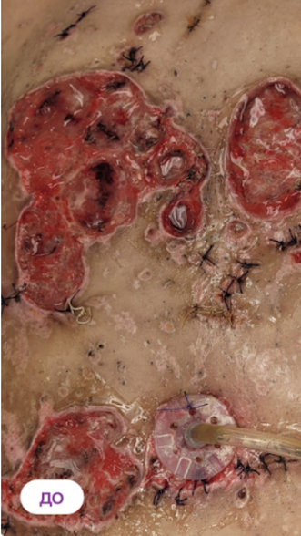 Фото ДО процедуры: Пересадка кожи