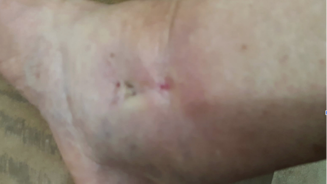 Фото ПОСЛЕ процедуры: Хронический остеомиелит