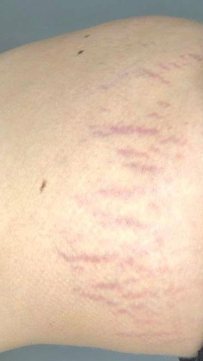 Фото ПОСЛЕ процедуры: Растяжки после беременности