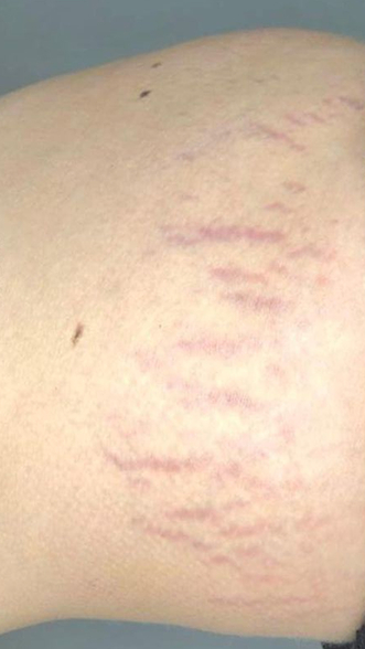 Фото ПОСЛЕ процедуры: Растяжки после беременности