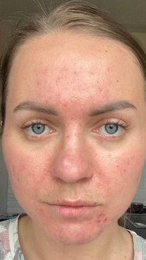 Фото ПОСЛЕ процедуры: Акне Розацеа