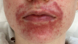 Фото ДО процедуры: Розацеа