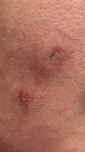 Фото ДО процедуры: Гипертрофический рубец