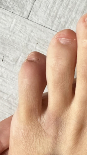 Фото ПОСЛЕ процедуры: Реабилитация после травмы