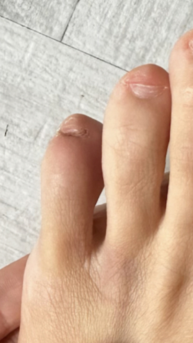 Фото ПОСЛЕ процедуры: Реабилитация после травмы