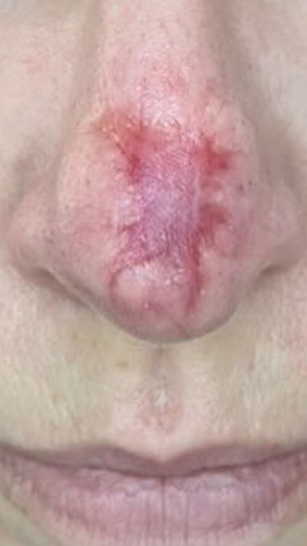 Фото ПОСЛЕ процедуры: Открытая рана носа