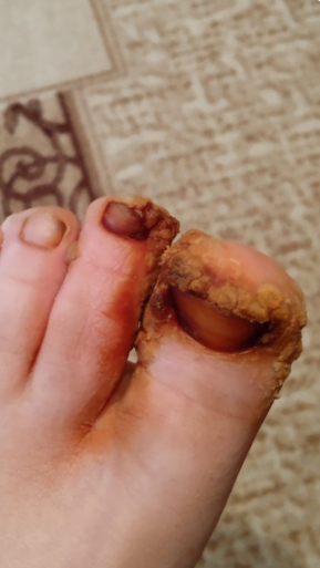 Фото ДО процедуры: Вирусные бородавки