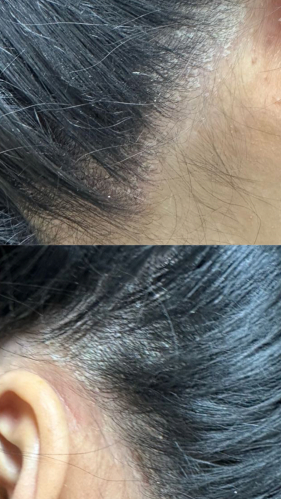 Фото ПОСЛЕ процедуры: Псориаз головы