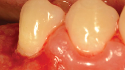 Фото ПОСЛЕ процедуры: Хронический пародонтит средней степени тяжести