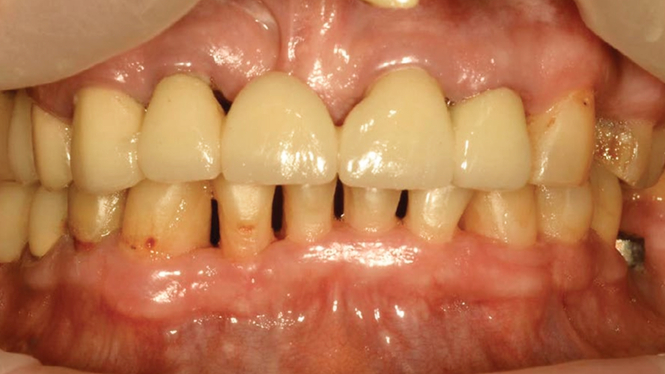 Фото ПОСЛЕ процедуры: Пародонтит тяжелой степени