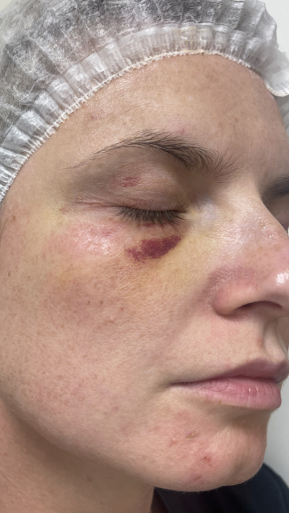 Фото ПОСЛЕ процедуры: Реабилитация после падения