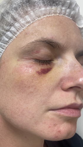 Фото ПОСЛЕ процедуры: Реабилитация после падения