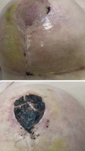 Фото ДО процедуры: Некроз и отёк ореол